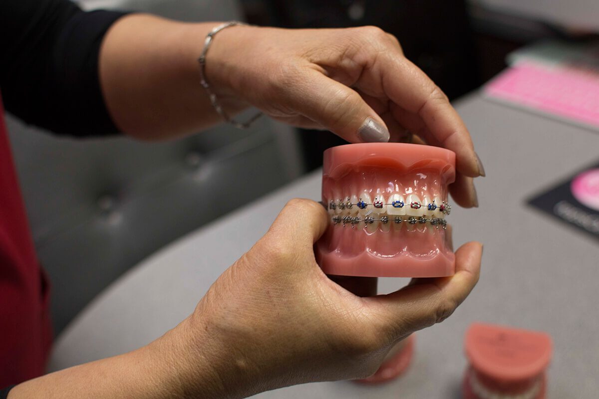 Braces-Demonstration