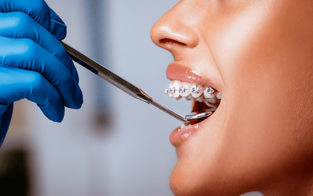 Top Orthodontic Treatments for a Perfect Smile