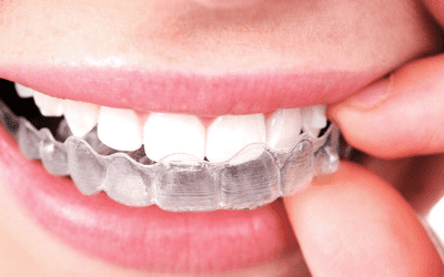 Clear Aligners vs. Braces: What to Choose?